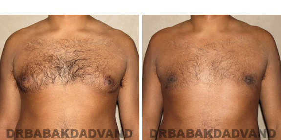 Gynecomastia. Before and After Treatment Photos - male, front view (patient 39)