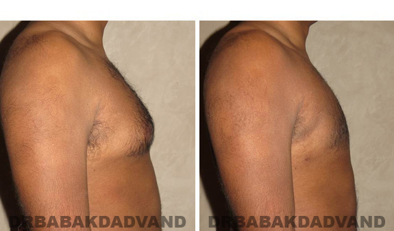 Gynecomastia. Before and After Treatment Photos - male, right side view (patient 39)