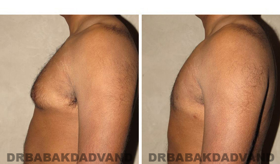 Gynecomastia. Before and After Treatment Photos - male, left side view (patient 39)