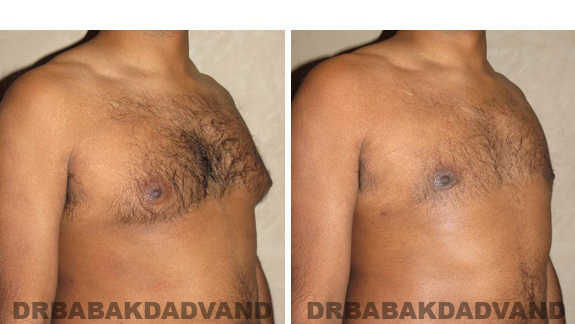 Gynecomastia. Before and After Treatment Photos - male, right side oblique view (patient 39)