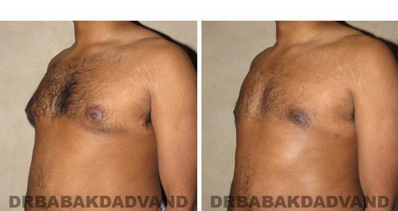Gynecomastia. Before and After Treatment Photos - male, left side oblique view (patient 39)