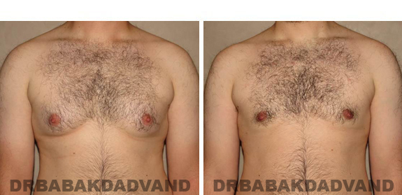 Gynecomastia. Before and After Treatment Photos - male, front view (patient 40)