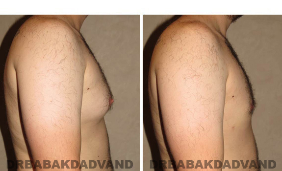 Gynecomastia. Before and After Treatment Photos - male, right side view (patient 40)