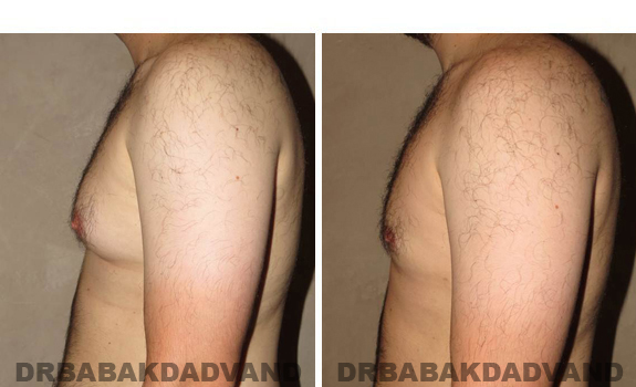 Gynecomastia. Before and After Treatment Photos - male, left side view (patient 40)