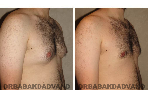 Gynecomastia. Before and After Treatment Photos - male, right side oblique view (patient 40)