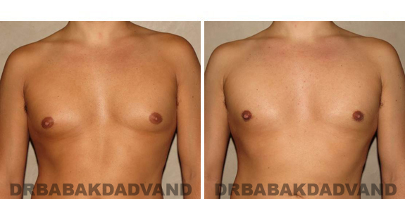 Gynecomastia. Before and After Treatment Photos - male, front view (patient 41)