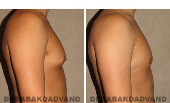 Gynecomastia. Before and After Treatment Photos - male, right side view (patient 41)
