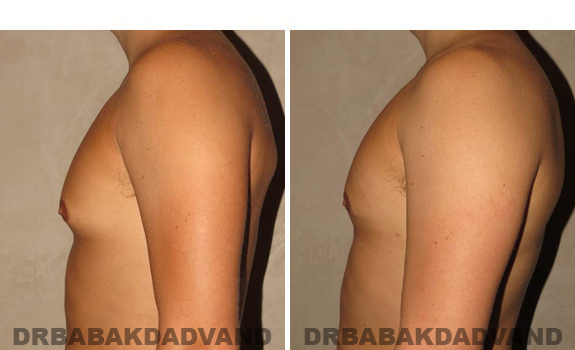 Gynecomastia. Before and After Treatment Photos - male, left side view (patient 41)
