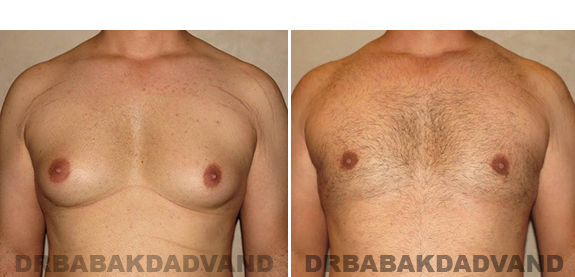 Gynecomastia. Before and After Treatment Photos - male, front view (patient 42)