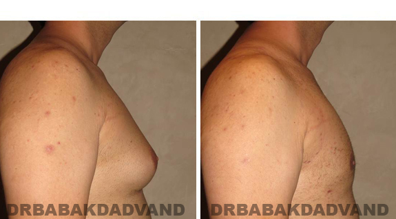 Gynecomastia. Before and After Treatment Photos - male, right side view (patient 42)