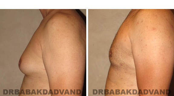 Gynecomastia. Before and After Treatment Photos - male, left side view (patient 42)