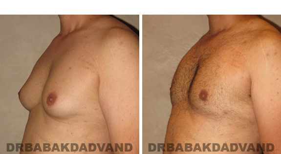 Gynecomastia. Before and After Treatment Photos - male, left side oblique view (patient 42)