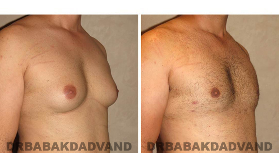 Gynecomastia. Before and After Treatment Photos - male, right side oblique view (patient 42)