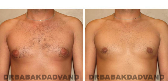 Gynecomastia. Before and After Treatment Photos - male, front view (patient 43)