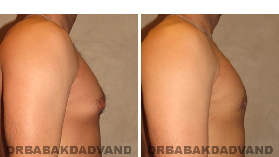 Gynecomastia. Before and After Treatment Photos - male, right side view (patient 43)