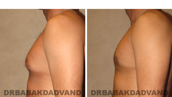 Gynecomastia. Before and After Treatment Photos - male, left side view (patient 43)