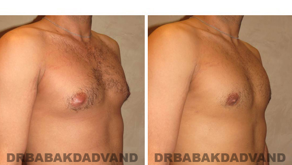 Gynecomastia. Before and After Treatment Photos - male, right side oblique view (patient 43)