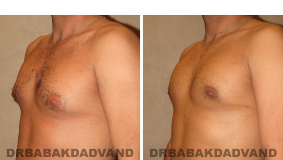 Gynecomastia. Before and After Treatment Photos - male, left side oblique view (patient 43)