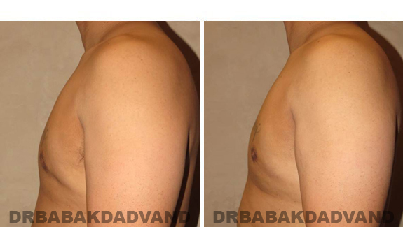 Gynecomastia. Before and After Treatment Photos - male, left side view (patient 44)