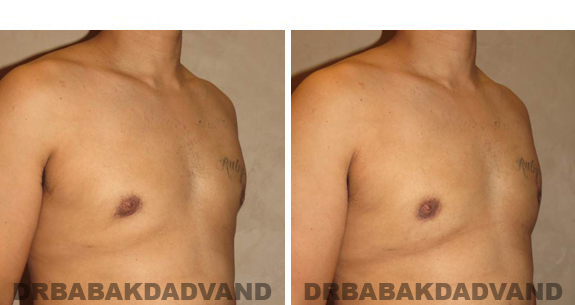 Gynecomastia. Before and After Treatment Photos - male, right side oblique view (patient 44)