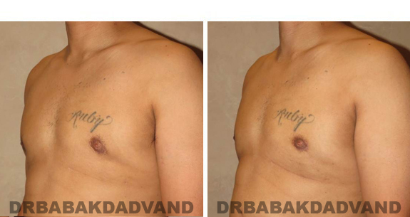Gynecomastia. Before and After Treatment Photos - male, left side oblique view (patient 44)