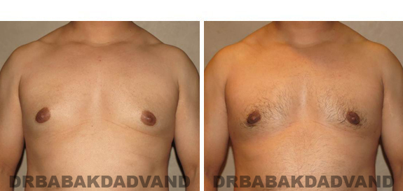 Gynecomastia. Before and After Treatment Photos - male, front view (patient 45)