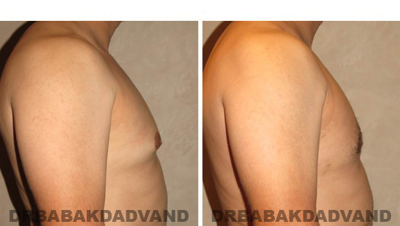 Gynecomastia. Before and After Treatment Photos - male, right side view (patient 45)