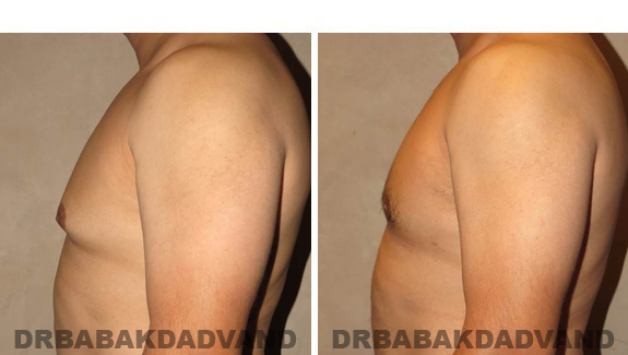 Gynecomastia. Before and After Treatment Photos - male, left side view (patient 45)