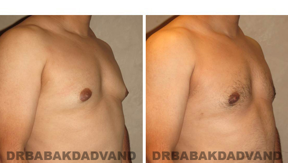 Gynecomastia. Before and After Treatment Photos - male, right side oblique view (patient 45)