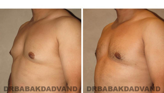 Gynecomastia. Before and After Treatment Photos - male, left side oblique view (patient 45)