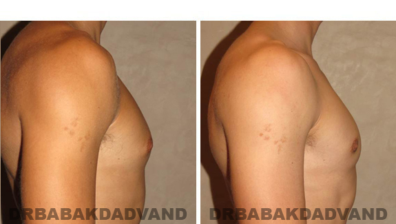 Gynecomastia. Before and After Treatment Photos - male, right side view (patient 46)
