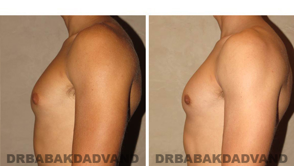 Gynecomastia. Before and After Treatment Photos - male, left side view (patient 46)