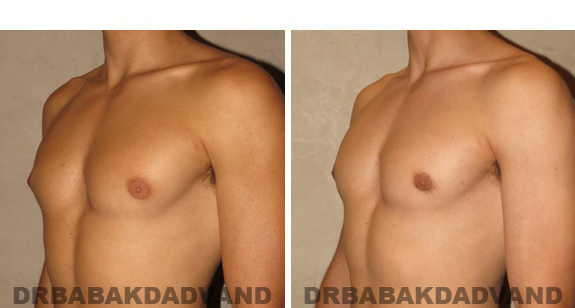 Gynecomastia. Before and After Treatment Photos - male, left side oblique view (patient 46)