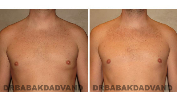 Gynecomastia. Before and After Treatment Photos , male, front view (patient 47)