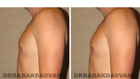 Gynecomastia. Before and After Treatment Photos , male, left side view (patient 47)