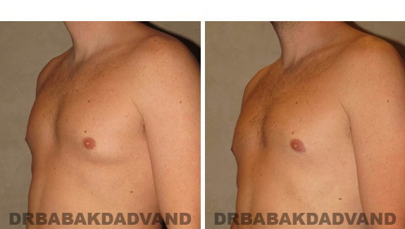 Gynecomastia. Before and After Treatment Photos , male, left side oblique view (patient 47)