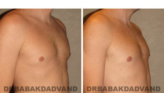 Gynecomastia. Before and After Treatment Photos , male, right side oblique view (patient 47)