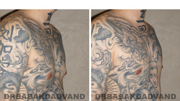 Gynecomastia. Before and After Treatment Photos  - male - right side oblique view (patient 49)