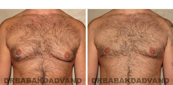 Gynecomastia. Before and After Treatment Photos - male,front view (patient - 49)
