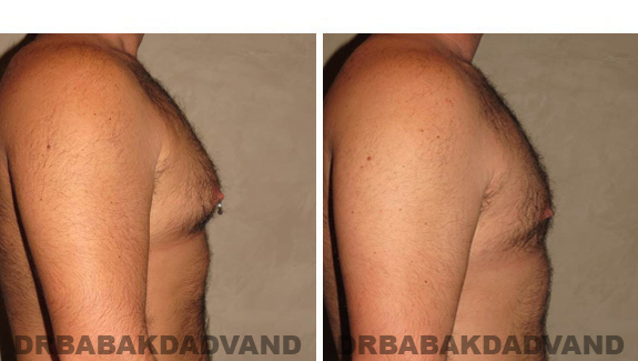 Gynecomastia. Before and After Treatment Photos - male - right side view (patient - 49)