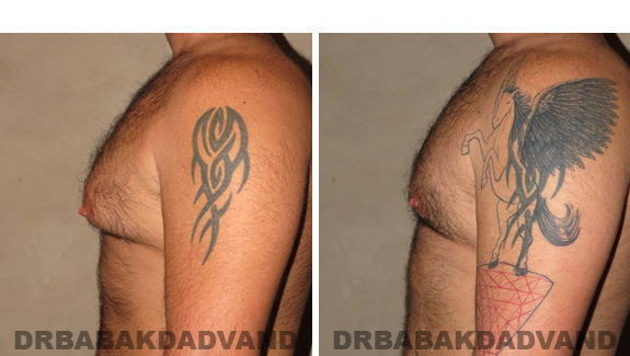 Gynecomastia. Before and After Treatment Photos - male - left side view (patient - 49)