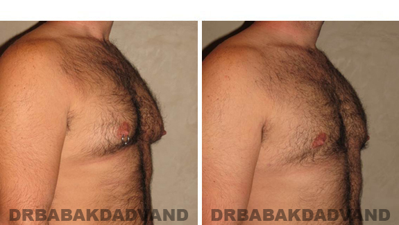 Gynecomastia. Before and After Treatment Photos - male - right side oblique view (patient - 49)