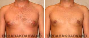 Before and After Treatment Photos: gynecomastia surgery- 32 year old patient