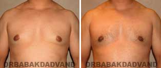 Before and After Treatment Photos: gynecomastia surgery- 27 year old patient