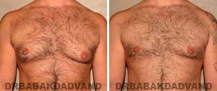 Before and After Treatment Photos: gynecomastia surgery- 40 year old patient