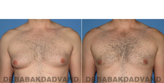 Gynecomastia. Before and After Treatment Photos - male - front view (patient - 56)