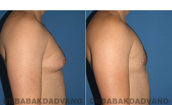Gynecomastia. Before and After Treatment Photos - male - right side view (patient - 56)