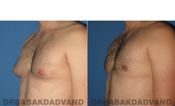 Gynecomastia. Before and After Treatment Photos - male - left side oblique view (patient 56)