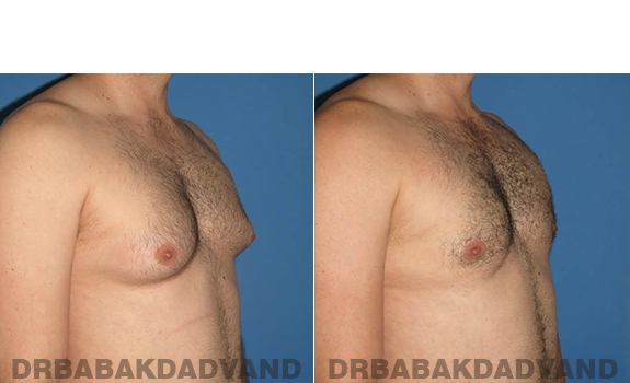 Gynecomastia. Before and After Treatment Photos - male - right side oblique view (patient - 56)