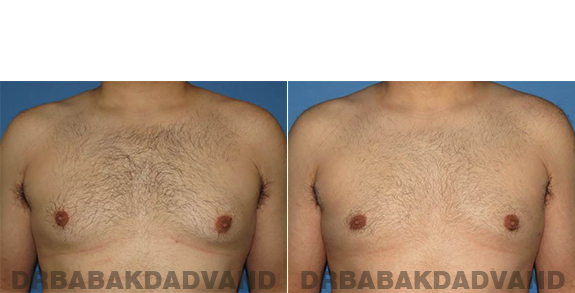 Gynecomastia. Before and After Treatment Photos - male - front view (patient - 57)